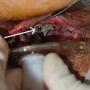 Tracheal dehiscence (white arrow) and surrounding slough just above the tracheostomy tube.