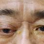 Photo of case 1 showed right eye redness, proptosis and temporal scalp swelling