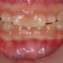 Anterior view of the dentition before treatment
